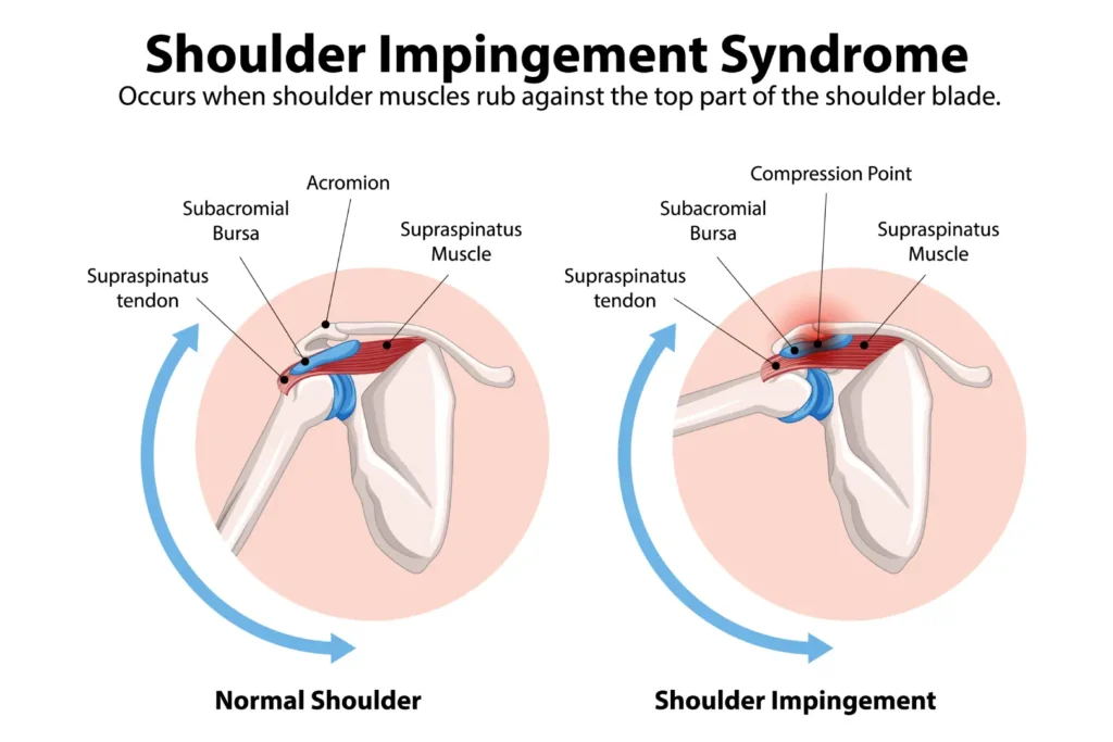 Dall’élite sportiva al paziente comune_ il metodo integrato per la spalla che unisce performance e riabilitazione 2