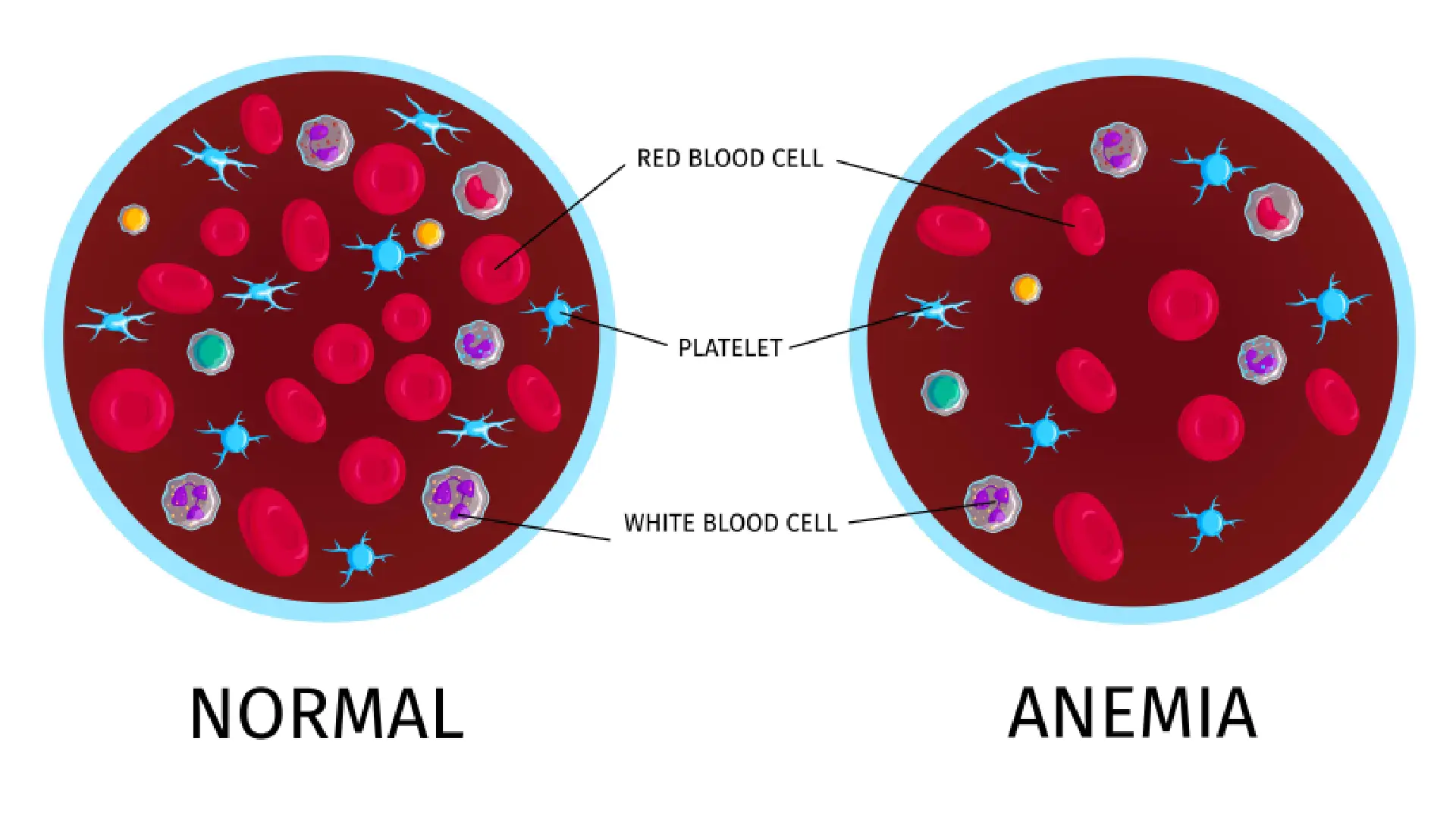 Iposideremia e anemia sideropenica