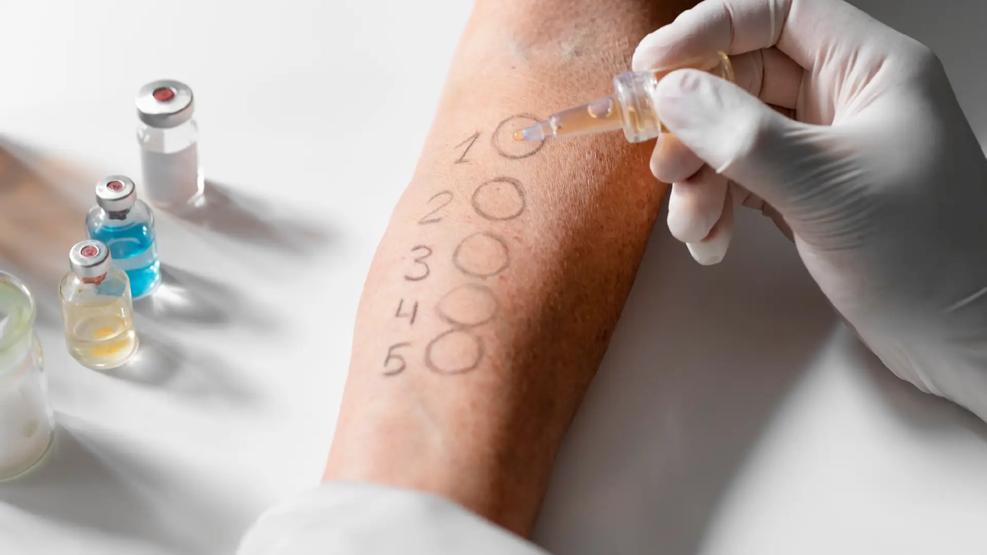 Sindrome dell'allergia al nichel